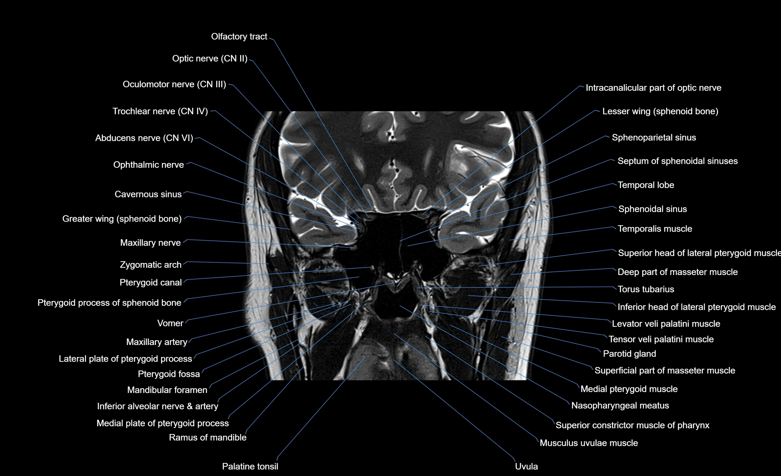 MRI face & paranasal sinuses(PNS) labelled  coronal  cross sectional anatomy 3T radiology  image-img-00001-00031.webp